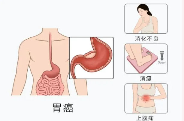 魔高一尺，道高一丈：胃腸鏡—消化道早癌克星
