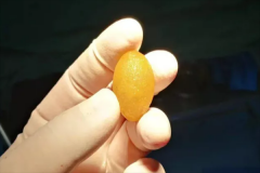 余生，“肝膽相照”——新式內(nèi)鏡微創(chuàng)保膽手術(shù)